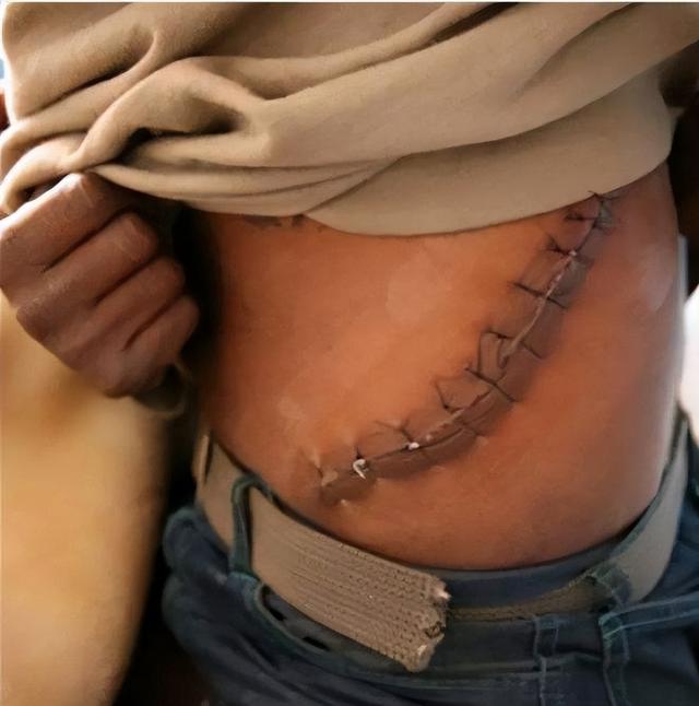 人的一個腎能值多少錢插圖3